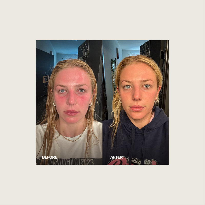 Sunburn relief in hours